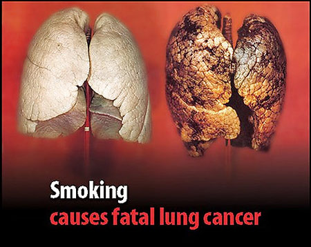 Anh: Bắt buộc in hình ảnh khuyến cáo về tác hại của thuốc lá lên vỏ bao