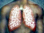 Bệnh phổi tắc nghẽn mãn tính, một hiểm họa thế giới