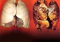 Đầu lọc thuốc lá bị kết tội làm tăng ung thư phổi