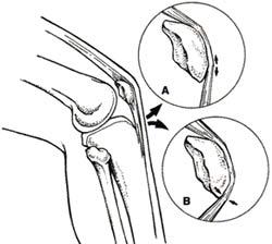 Nhận dạng bào gốc trong dây gân