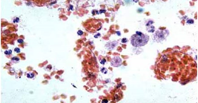 Xuất hiện Amip ăn não người