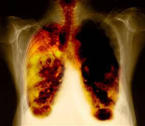 Phát hiện ba loại gen mới gây ung thư phổi