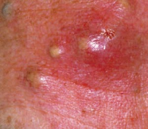 MRSA nguy hiểm hơn HIV