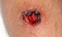 MRSA nguy hiểm hơn HIV