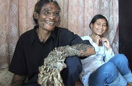 “Người cây” ở Indonesia