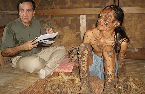 “Người cây” ở Indonesia