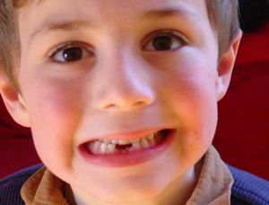 Mất răng sớm ảnh hưởng đến sức khỏe răng miệng của trẻ