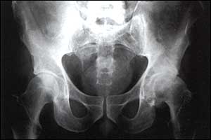 Đàn ông béo phì có nguy cơ bị viêm khớp xương hông và đầu gối
