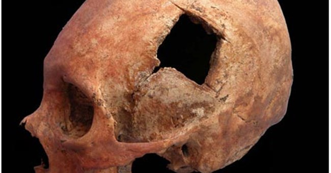 Phẫu thuật não của người Inca thuộc dạng <i>“trình độ cao”</i>