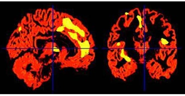 Ký ức đau buồn làm thay đổi lượng chất xám trong não