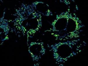 Phần tử nano giúp tiêu diệt tế bào ung thư