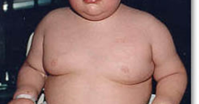 Bác sĩ không chuẩn đoán chính xác tình trạng thừa cân ở trẻ