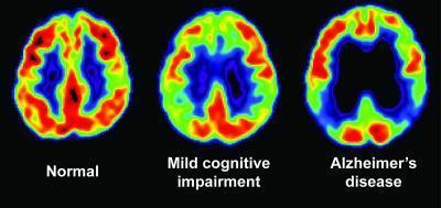 Kiểm tra trí nhớ và PET scan giúp phát hiện những dấu hiệu sớm của bệnh mất trí