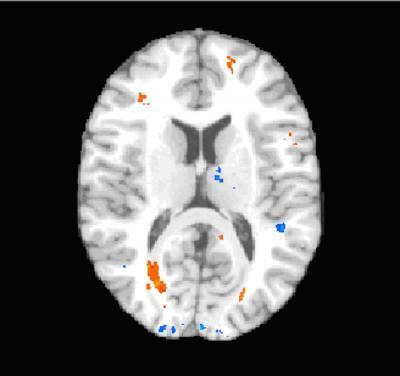 Mối liên hệ giữa chấn động và tổn thương mô não