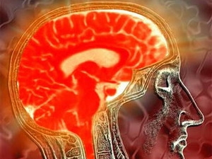 Phương pháp mới xử lý u não không cần mở hộp sọ 