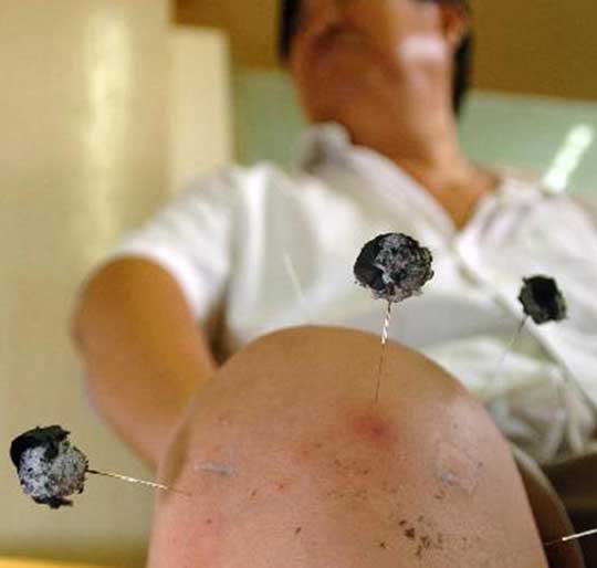 Những thủ pháp châm cứu đặc biệt của người Trung Quốc