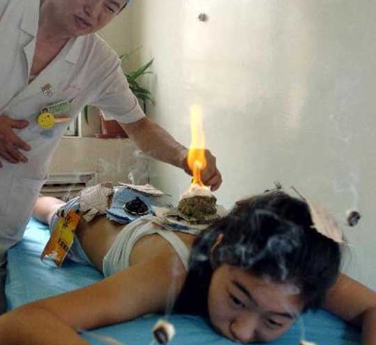 Những thủ pháp châm cứu đặc biệt của người Trung Quốc