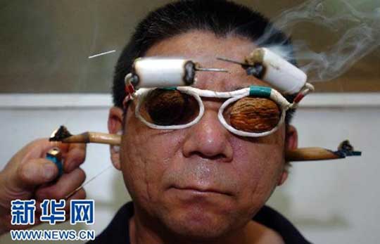 Những thủ pháp châm cứu đặc biệt của người Trung Quốc