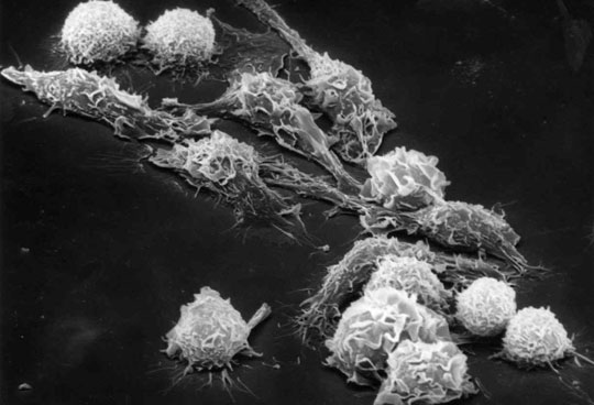 Virus EBV là nguyên nhân gây ra các bệnh ung thư? 