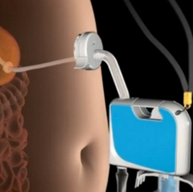 Giảm cân bằng máy hút thức ăn  