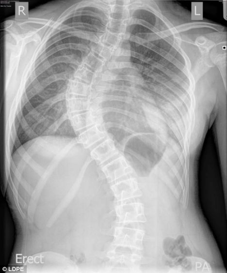 Nữ sinh bị vẹo cột sống 90 độ