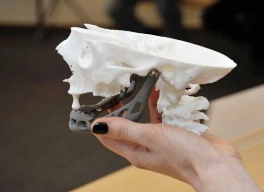 Máy in 3D "đúc" xương hàm cho cụ bà 83 tuổi 
