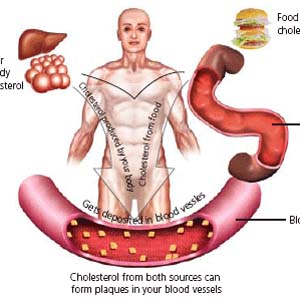 Cholesterol HDL giúp giảm nguy cơ ung thư ruột