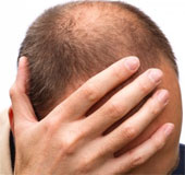 Nam giới hói đầu có nguy cơ mắc bệnh mạch vành