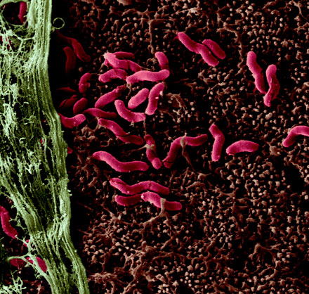 Vi khuẩn Helicobacter pylori có thể là thủ phạm gây ra căn bệnh Parkinson