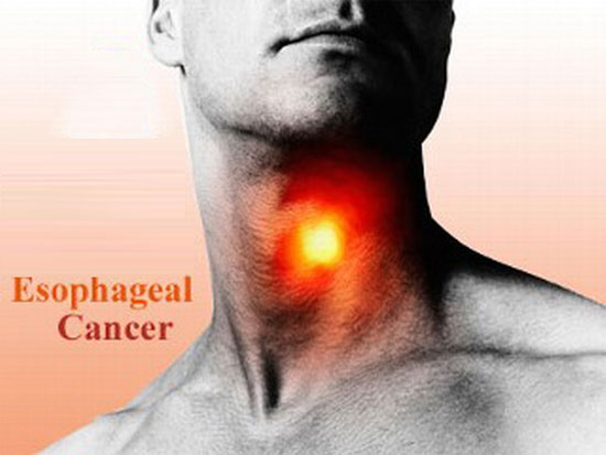 Phát hiện các biến thể gene gây ung thư thực quản