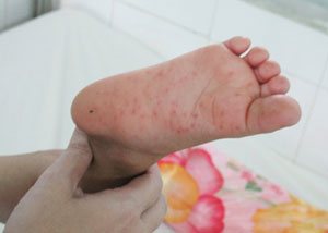 Xuất hiện bệnh chân tay miệng tại Hà Nội