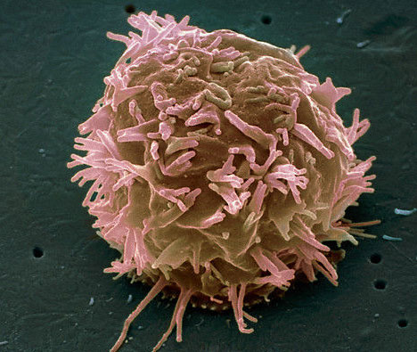 Phát hiện mới về cơ chế di căn của tế bào ung thư 