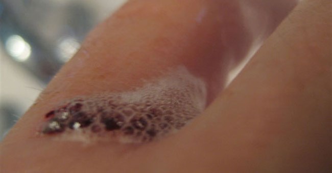 Khả năng làm lành vết thương của oxy già