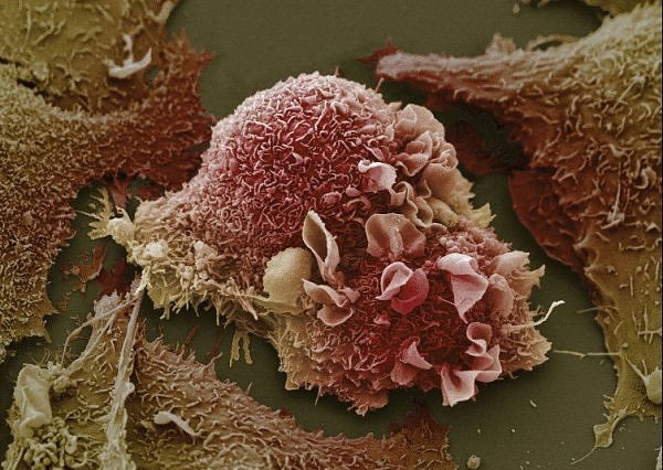 Tế bào ung thư vú có thể kháng lại hệ miễn dịch