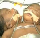 Video: Bé trai 2 đầu chào đời tại Ấn Độ