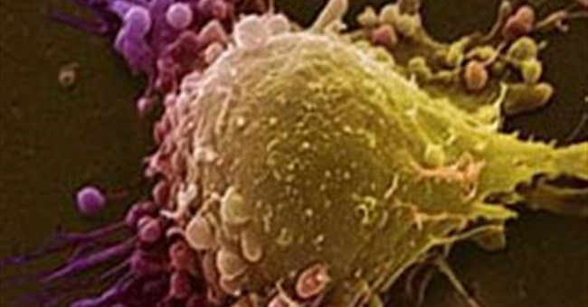 5 biến thể gen liên quan tới ung thư tiền liệt tuyến