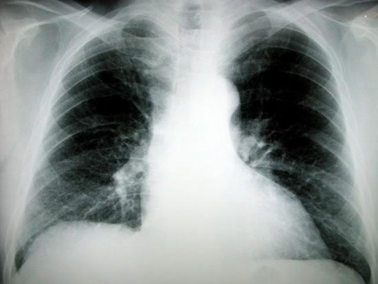 Cuba sắp ra mắt vắcxin có thể điều trị ung thư phổi 