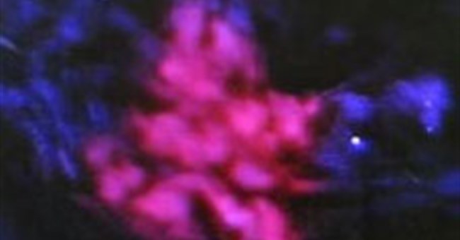 Australia: Thuốc mới giúp tế bào ung thư phát sáng