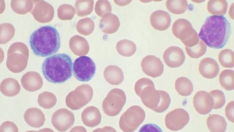 Lymphocytyic bệnh bạch cầu mãn tính trong máu.