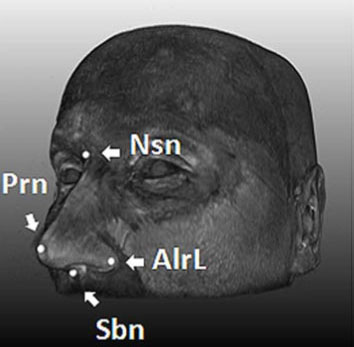 Xác định 5 gene quy định hình dạng khuôn mặt 