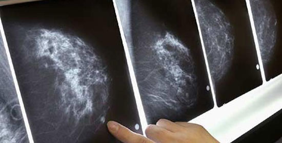 Điểm tương đồng giữa ung thư vú và buồng trứng
