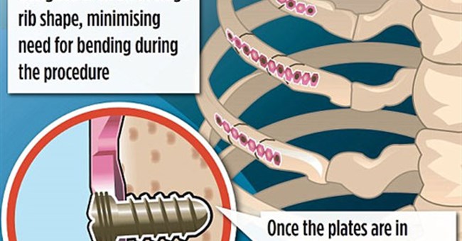 Synthes Rib Matrix - phương pháp phẫu thuật mới giúp xương gãy mau hồi phục
