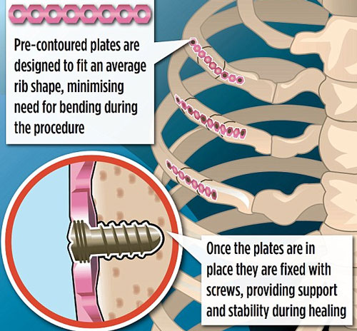Synthes Rib Matrix - phương pháp phẫu thuật mới giúp xương gãy mau hồi phục