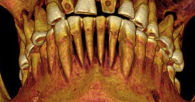 Phát hiện xác ướp chết vì sâu răng