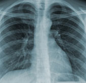 Kiểm tra lao phổi không cần chụp X-quang nhờ thiết bị mới
