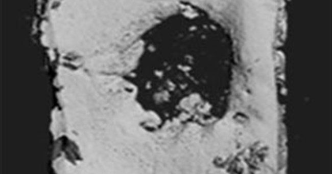 Cao dán sinh học giúp tái tạo xương một cách tự nhiên