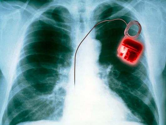 Việc cấy máy trợ tim vào ngực sẽ trở thành quá khứ khi “máy trợ tim sinh học” ra đời. 