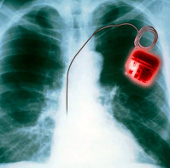 Triển vọng phát triển “máy trợ tim sinh học”