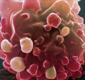 Phát hiện hai gene thủ phạm gây ung thư ruột