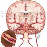 Xét nghiệm máu giúp dự báo đột quỵ